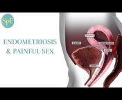 Sex, Pain u0026 Endometriosis