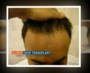 FOR more details CLICK www.fuepakistan.comnWhat is Pakistan hair transplant?nWhat is hair transplant surgery strip method?nWhat is follicular unit extraction FUE Pakistan?nWho is the best FUE doctor in Pakistan?nWhich is the best hair transplant center in Pakistan?nHow can I find affordable hair transplant in Pakistan?nWhat is strip method of hair TransplantationnWhat is