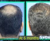 The index patient was 47 years old when he came in for the hair transplantation procedure with us. He was Grade VI on the Norwood Hamilton Scale of baldness. We decided to give him a total of 6000 grafts for his entire scalp coverage. We took 4700 grafts from his scalp and 1300 grafts from his beard. We also suggested his medications for the preservation of his pre-existing hair.nThe growth was promising at 6 months with a complete look change. By the 10th month, the results were extremely good