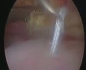 http://www.shoulder-arthroscopy.co.uk/nnArthroscopy Bursoscopy and Cuff Repair - Left ShouldernnNew and improved video with voice-overs from Consultant Orthopedic surgeons Mr. Simon Moyes and Mr. Omar Haddo