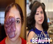 ELLAHE Haghani from Iran, was born with Sturge Weber syndrome - a rare vascular disorder that’s marked by a distinctive port-wine stain on the face. She told Truly: “When I was born it was just a discoloration to the right side, but as I grew the soft tissue began to grow and became bigger and thicker.” Having a facial difference affected Ellahe’s confidence and people would often stare at her, some even said she shouldn’t come out of the house. “It wasn’t easy for me. My birthmark did hold me back,” she explained. Doctors were too afraid to operate on Ellahe as it was deemed too risky, but that all changed when she was introduced to Dr Hamid Adib. He brought Ellahe over to the US and put her in touch with Dr Milton Waner and his team, who were able to help. So far, she’s had 25 operations and is forever grateful for the life-changing surgery. Speaking about her appearance, Ellahe said: “When I look at myself in the mirror, I love the way I look. In my own eyes, I see myself as perfect.”&#60;br/&#62;&#60;br/&#62;Follow Ellahe&#39;s journey here:&#60;br/&#62;https://www.instagram.com/ellahehaghani/and here - https://www.facebook.com/ellahe.haghani