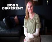 SANJA was born with the rare skin condition, Epidermolysis Bullosa - EB for short - which causes blisters to form uncontrollably on her skin, which will then &#92;