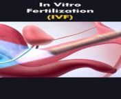 In Vitro Fertilization (IVF) Process 3D Animation&#60;br/&#62;#ivf #invitrofertilization #ivfprocess #birthcontrol #birthoptions #embryo #embryotransfer #artificialbirth #birthproblems #medical3danimation #3dmedicalanimation #fertilitytreatment #infertility #fertilityawareness #fertilitydoctor