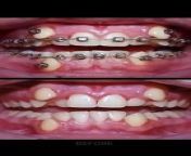 braces,time lapse,braces time lapse,brackets,time lapse braces,dental braces,braces in mouth time lapse,braces journey time lapse,clear braces,getting braces,adult braces,braces update,braces timelapse,braces treatment,braces on,braces before and after,fixing teeth time lapse,braces vlog,braces transformation,do braces hurt,braces colors,do i need braces,how braces work,braces journey,braces gaps,before and after braces,tips for braces