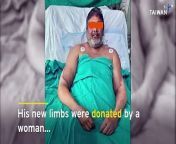An Indian man who lost both of his hands in a train accident has received new limbs from a woman.