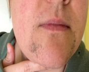 A woman who grew facial hair aged 13 and spent &#36;10k on laser hair removal has now accepted her beard and says it doesn&#39;t &#92;