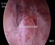 This video shows Diagnostic Hysteroscopy performed by Dr R K Mishra at World Laparoscopy Hospital. Hysteroscopy is a procedure that allows your doctor to look inside your uterus in order to diagnose and treat causes of abnormal bleeding. Hysteroscopy is done using a hysteroscope, a thin, lighted tube that is inserted into the vagina to examine the cervix and inside of the uterus. Hysteroscopy can be either diagnostic or operative.&#60;br/&#62;&#60;br/&#62;Read More information - &#60;br/&#62;https://www.laparoscopyhospital.com/SERV01.HTM