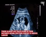Twins almost kill each other in their mother's womb, doctors forced to induce labour from view to kill mayday